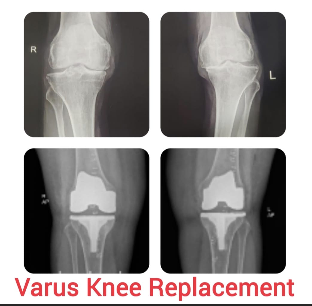 Knee X-ray 1